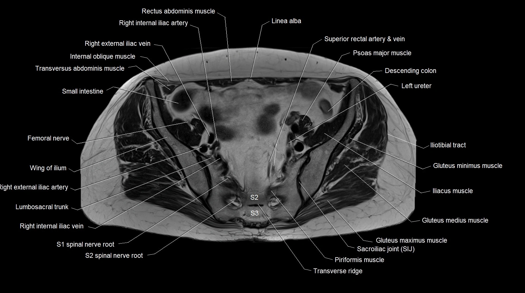 MRI 3T pelvis axial cross section anatomy image 13.webp